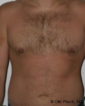 Male Breast Reduction - Before & After - Dr. Placik