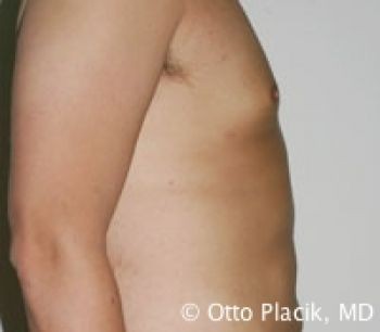 Male Breast Reduction - Before & After - Dr. Placik