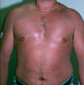 Male Breast Reduction - Before & After - Dr. Placik