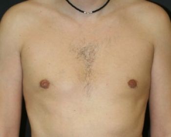 Male Breast Reduction - Before & After - Dr. Placik