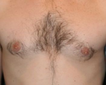 Male Breast Reduction - Before & After - Dr. Placik