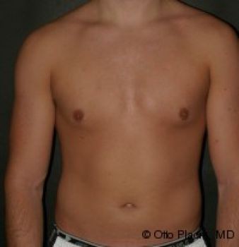 Male Breast Reduction - Before & After - Dr. Placik