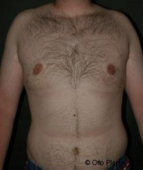 Male Breast Reduction - Before & After - Dr. Placik