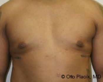 Male Breast Reduction