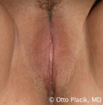 Labiaplasty Chicago