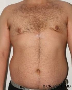 Male Breast Reduction