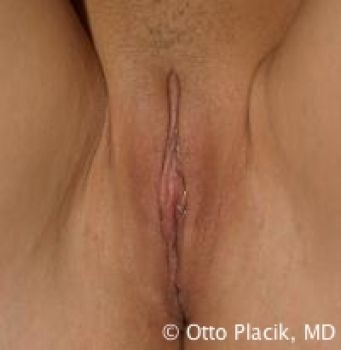 Labiaplasty Before and After Chicago