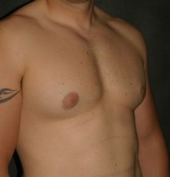 Male Breast Reduction - Before & After - Dr. Placik