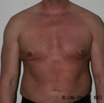 Male Breast Reduction - Before & After - Dr. Placik