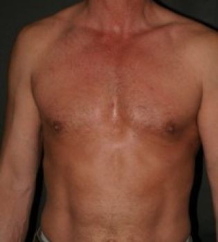 Male Breast Reduction - Before & After - Dr. Placik