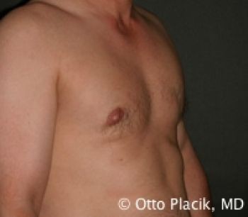 Male Breast Reduction - Before & After - Dr. Placik