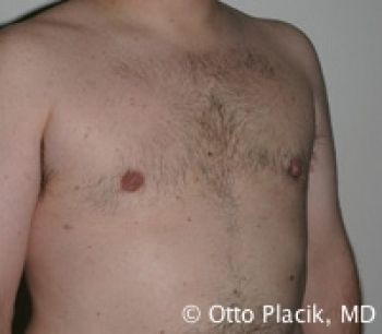 Male Breast Reduction - Before & After - Dr. Placik