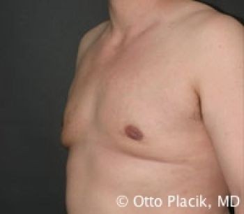 Male Breast Reduction - Before & After - Dr. Placik