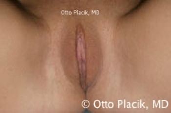 Labiaplasty with and without Clitoral Hood Reduction - Before & After - Dr. Placik