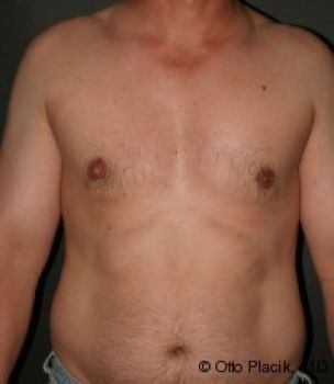 Male Breast Reduction - Before & After - Dr. Placik