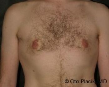 Male Breast Reduction - Before & After - Dr. Placik