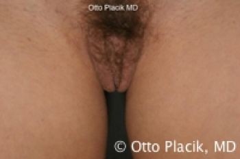 Labiaplasty with and without Clitoral Hood Reduction - Before & After - Dr. Placik