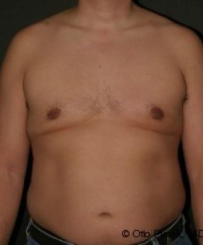 Male Breast Reduction - Before & After - Dr. Placik