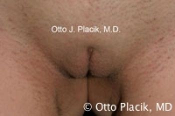 Labiaplasty with and without Clitoral Hood Reduction - Before & After - Dr. Placik