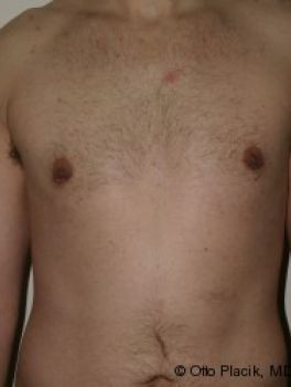 Male Breast Reduction - Before & After - Dr. Placik