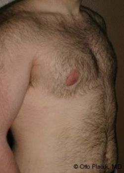 Male Breast Reduction - Before & After - Dr. Placik