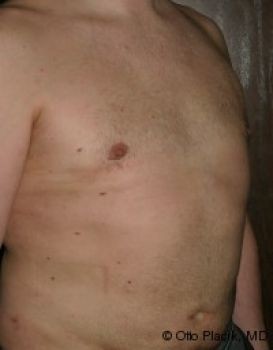 Male Breast Reduction - Before & After - Dr. Placik