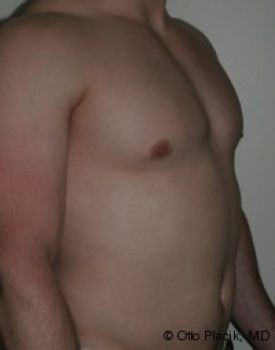 Male Breast Reduction - Before & After - Dr. Placik