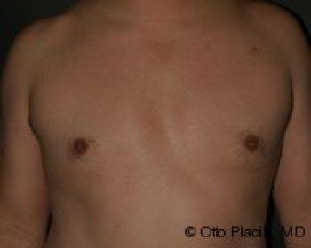 Male Breast Reduction - Before & After - Dr. Placik