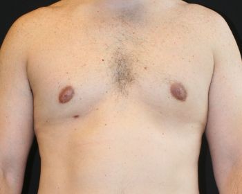 Male Breast Reduction - Before & After - Dr. Placik