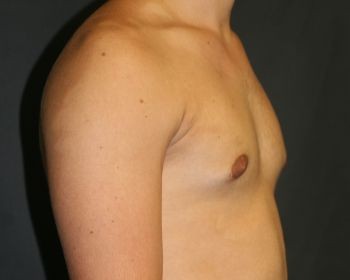 Male Breast Reduction - Before & After - Dr. Placik