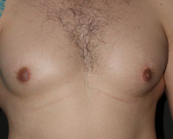 Male Breast Reduction - Before & After - Dr. Placik