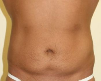 Male Liposuction - Before & After - Dr. Placik