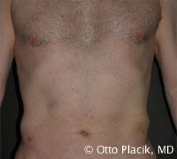 Male Liposuction - Before & After - Dr. Placik