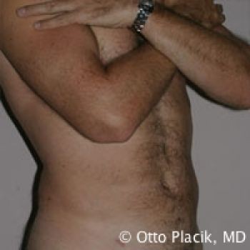 Male Liposuction - Before & After - Dr. Placik