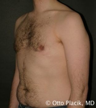 Male Liposuction - Before & After - Dr. Placik