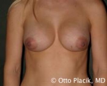 Before & After Breast Augmentation Gallery - Before & After - Dr. Placik