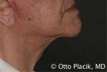 Male Neck Lift - Before & After - Dr. Placik