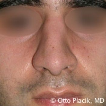 Male Rhinoplasty in Chicago