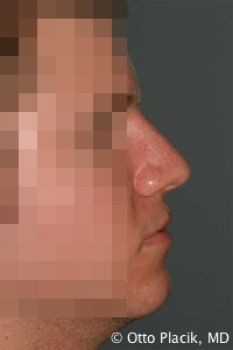 Male Rhinoplasty - Before & After - Dr. Placik