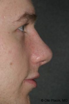 Male Rhinoplasty - Before & After - Dr. Placik