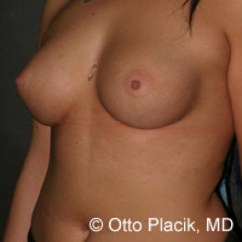 Before & After Breast Augmentation Gallery - Before & After - Dr. Placik