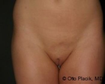 Mons Pubis Reduction - Before & After - Dr. Placik