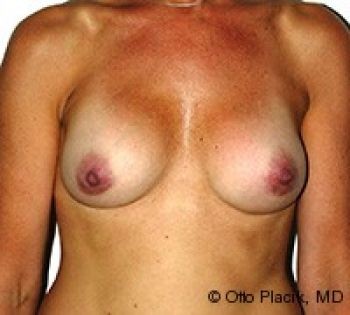 Before & After Breast Augmentation Gallery - Before & After - Dr. Placik