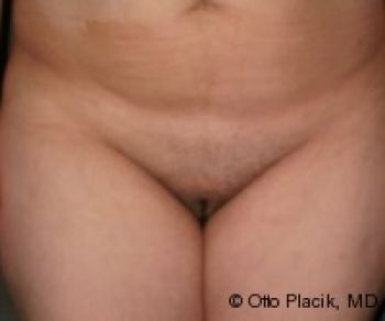 Mons Pubis Reduction - Before & After - Dr. Placik