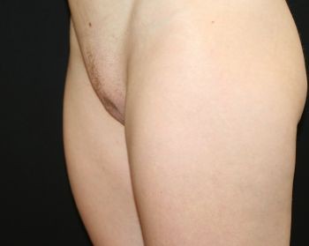 Mons Pubis Reduction - Before & After - Dr. Placik