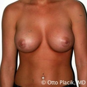 Before & After Breast Augmentation Gallery - Before & After - Dr. Placik