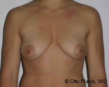 Before & After Breast Augmentation Gallery - Before & After - Dr. Placik