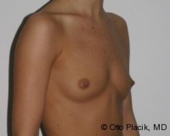 Breast Augmentation Chicago