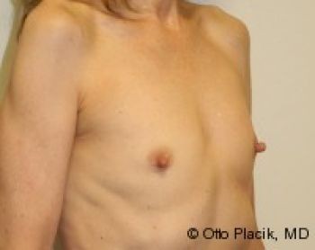 Breast Augmentation Chicago