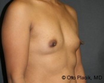 Breast Augmentation Chicago